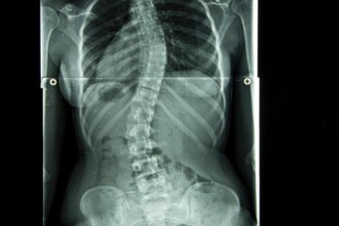 escoliosis